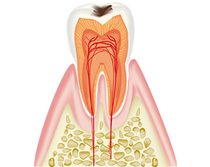 少し削って詰めるだけ　通院回数1回