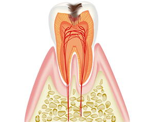 削って型を取って詰め物をする　通院回数およそ2回