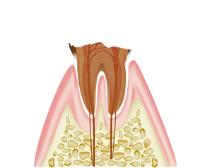 歯を抜く　長期通院が必要