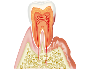 歯周炎（軽度）