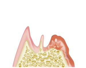 歯周炎（重度）